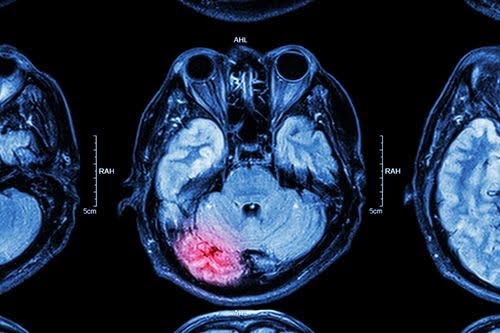 liability-in-traumatic-brain-injury-cases