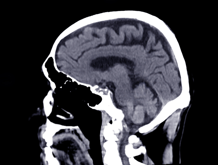 what is cte brain injury