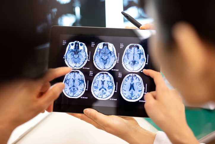 Doctors analyzing brain scan - Is a brain bleed a traumatic brain injury?